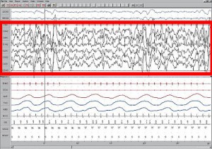  le onde cerebrali (durante una delle varie fasi del sonno) rappresentate graficamente