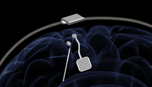 Realizzato pacemaker per cervello, nuovi trattamenti per epilessia e Parkinson? 1